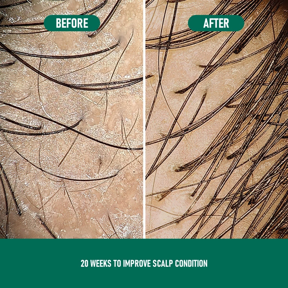 PHOFAY Minoxidil Anti-Hair Loss Mousse