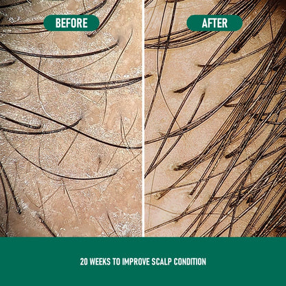 PHOFAY Minoxidil Anti-Hair Loss Mousse