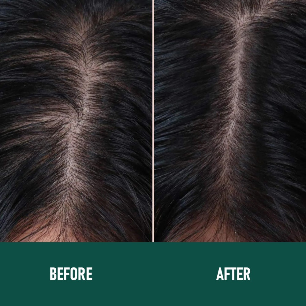 PHOFAY Minoxidil Anti-Hair Loss Mousse