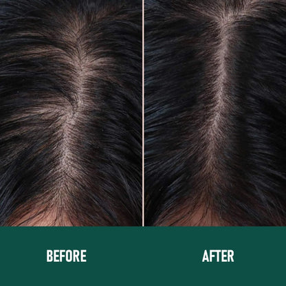 PHOFAY Minoxidil Anti-Hair Loss Mousse