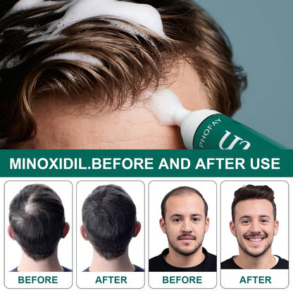 PHOFAY Minoxidil Anti-Hair Loss Mousse